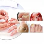 لاصقات علاج وإصلاح الأظافر - 10