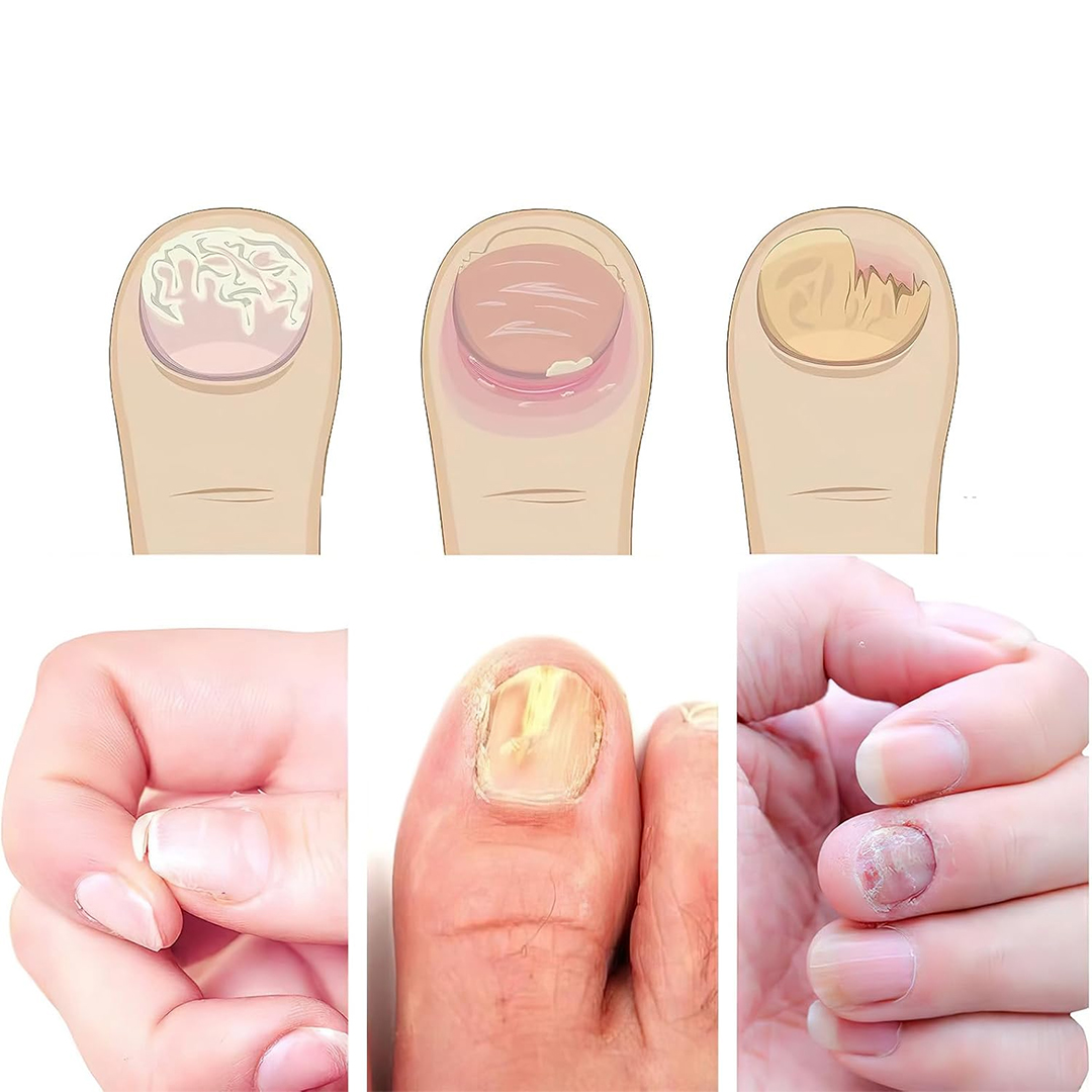 لاصقات علاج وإصلاح الأظافر - 6