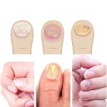 لاصقات علاج وإصلاح الأظافر - 6