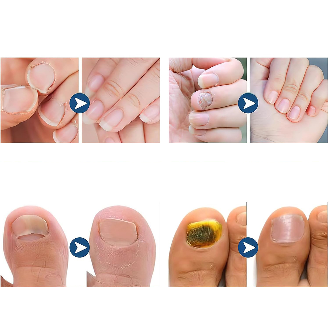 لاصقات علاج وإصلاح الأظافر - 7
