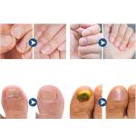 لاصقات علاج وإصلاح الأظافر - 7