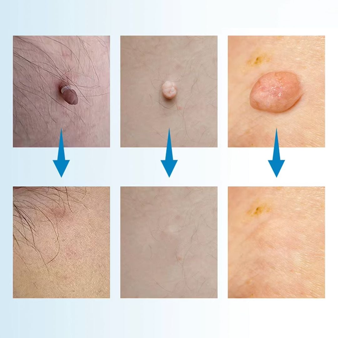 Skin Tag Removal Kit - 4