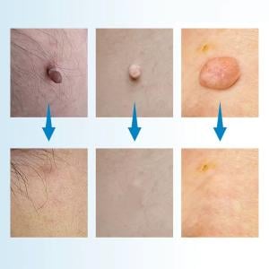 Skin Tag Removal Kit - 5