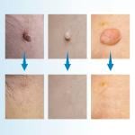 Skin Tag Removal Kit - 4