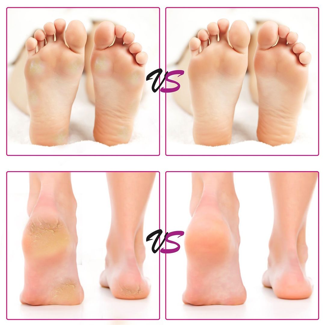 Electric Foot Care Tool product thumbnail 11
