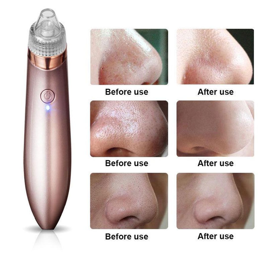 Pore Vacuum Blackhead Remover product thumbnail 12