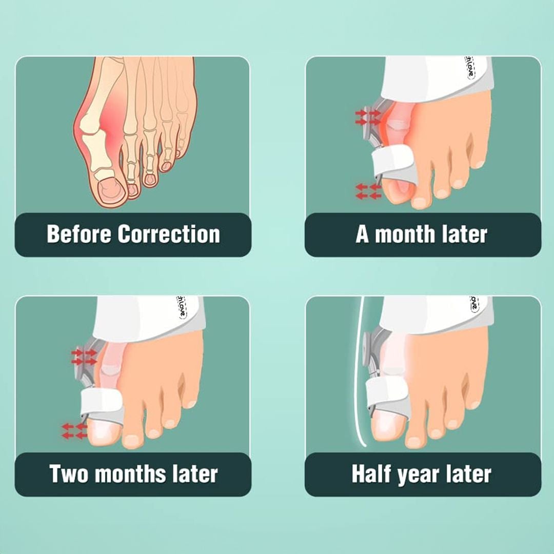 Adjustable Hallux Corrector Device product thumbnail 8