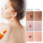 Skin Tag Removal Kit - 7
