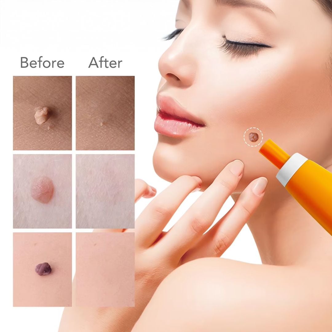 Skin Tag Removal Kit - 1