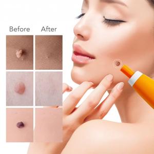 Skin Tag Removal Kit - 2