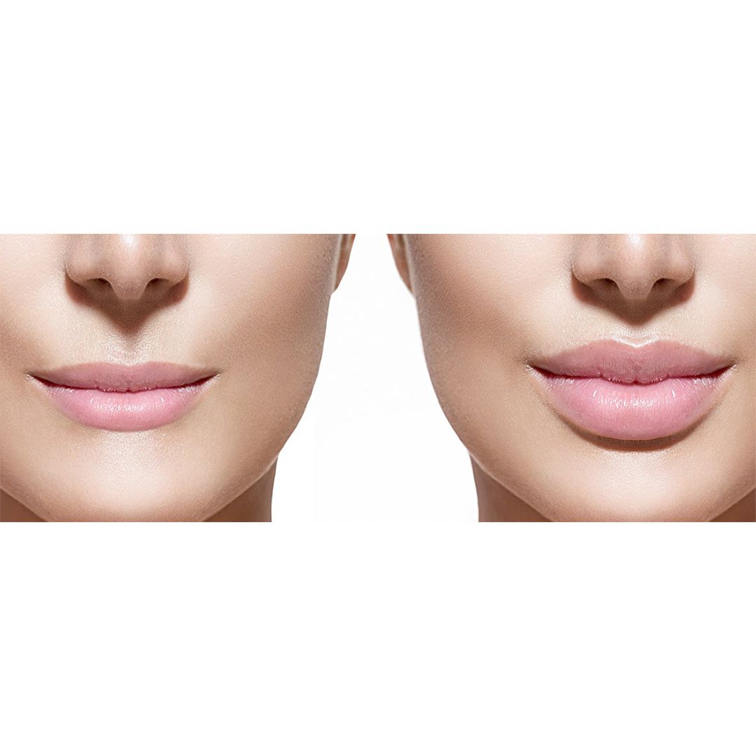 Lip Plumping Machine product thumbnail 6
