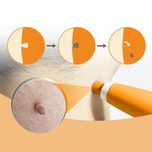 Skin Tag Removal Kit - 3